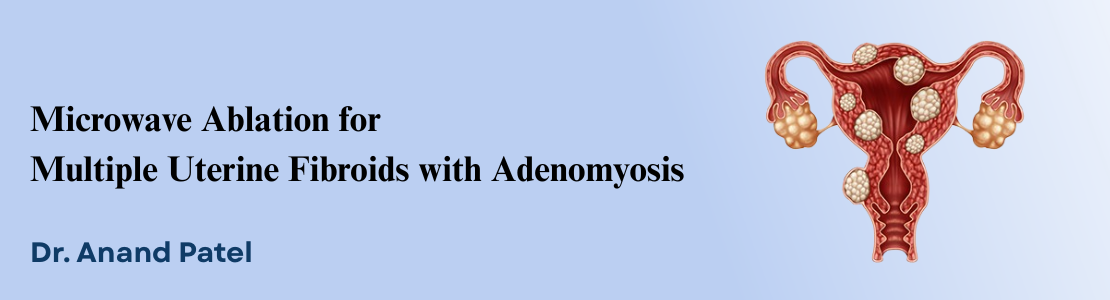 Microwave Ablation for Multiple Uterine Fibroids with Adenomyosis